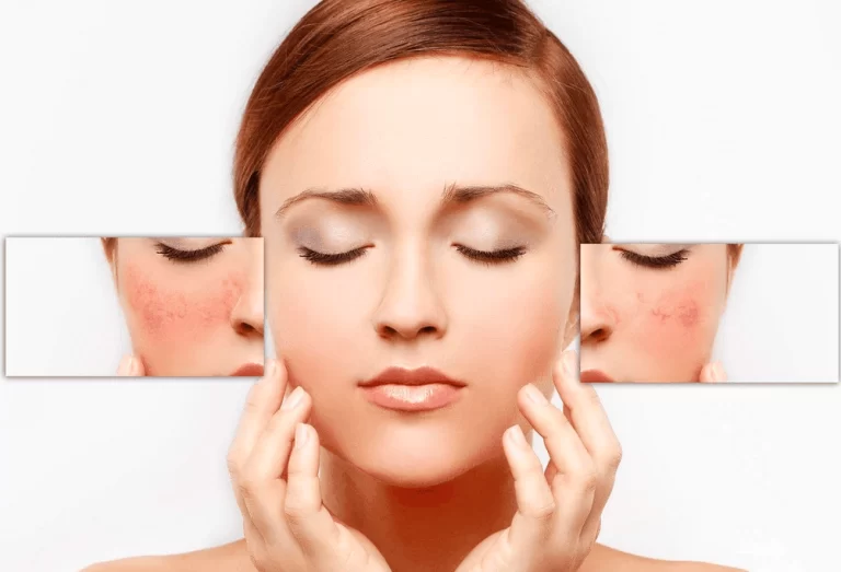 Làm Gì Khi Bị Kích Ứng Mỹ Phẩm? Hướng Dẫn Xử Lý Từ A đến Z