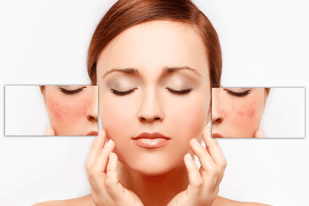 Làm Gì Khi Bị Kích Ứng Mỹ Phẩm? Hướng Dẫn Xử Lý Từ A đến Z